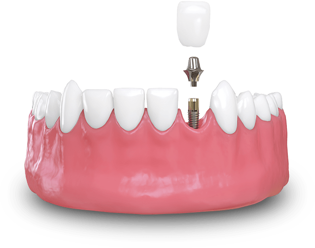 dental implant model.